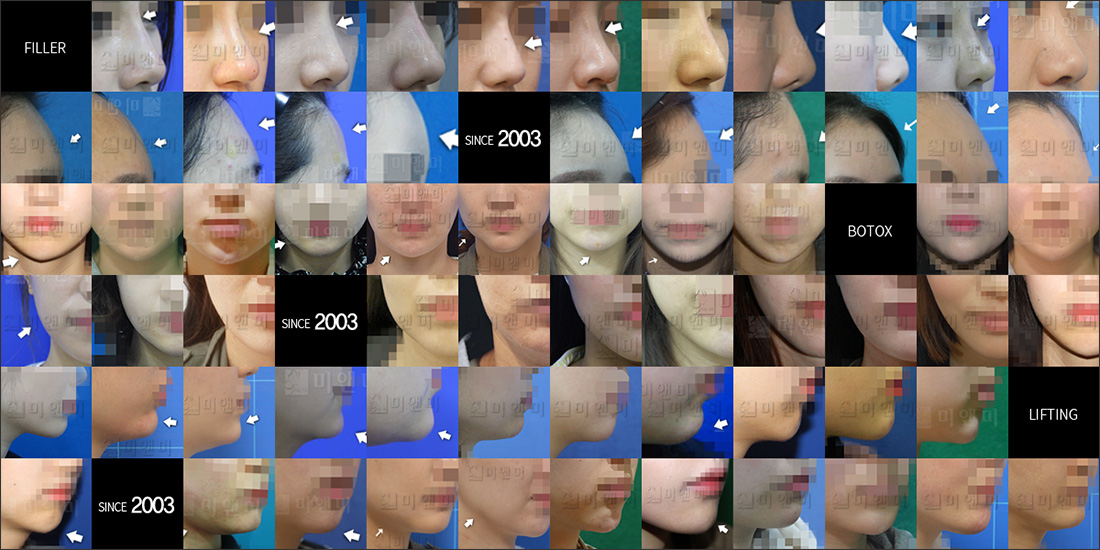 SINCE 2003 MI&MI, 시술후사진모음 부평HPL, 부평역HPL